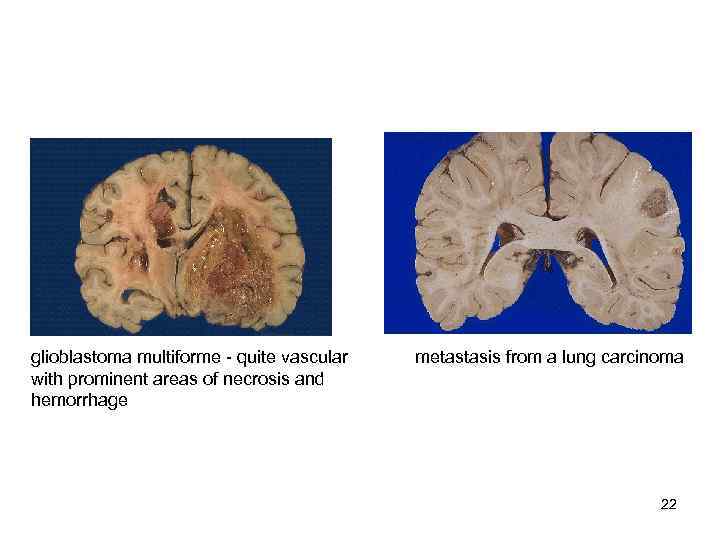 glioblastoma multiforme  quite vascular  metastasis from a lung carcinoma with prominent areas