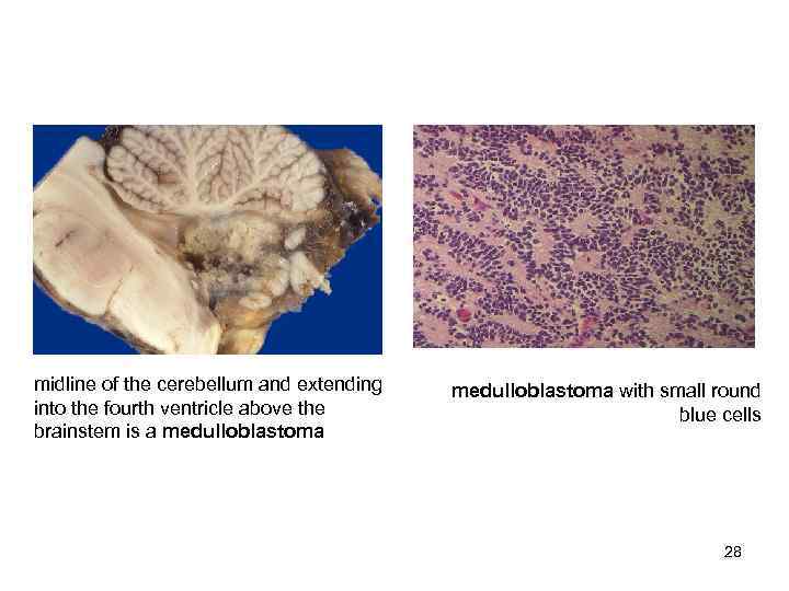 midline of the cerebellum and extending  medulloblastoma with small round into the fourth
