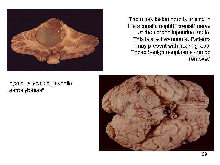        The mass lesion here is arising in
