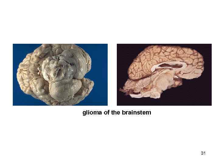 glioma of the brainstem      31 
