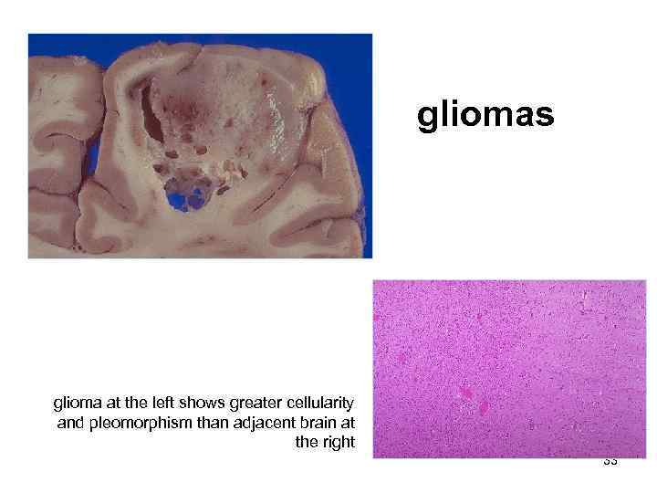     gliomas glioma at the left shows greater cellularity and pleomorphism