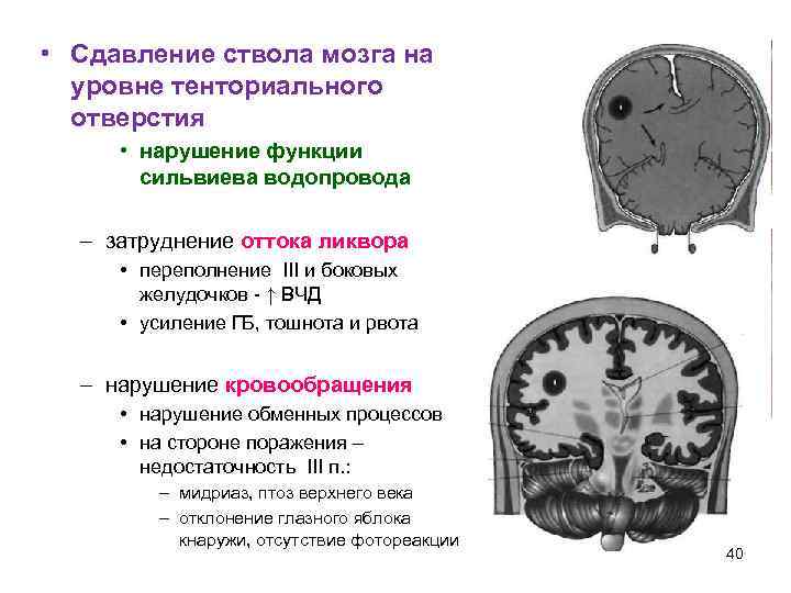  • Сдавление ствола мозга на  уровне тенториального  отверстия  • нарушение