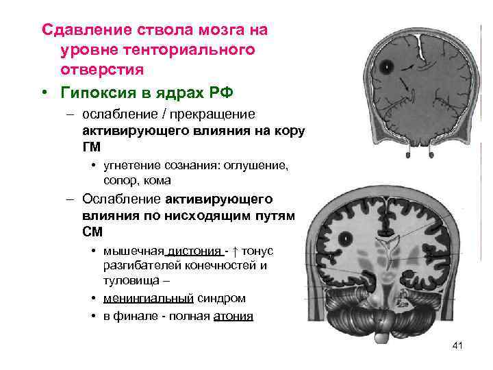 Сдавление ствола мозга на  уровне тенториального  отверстия • Гипоксия в ядрах РФ