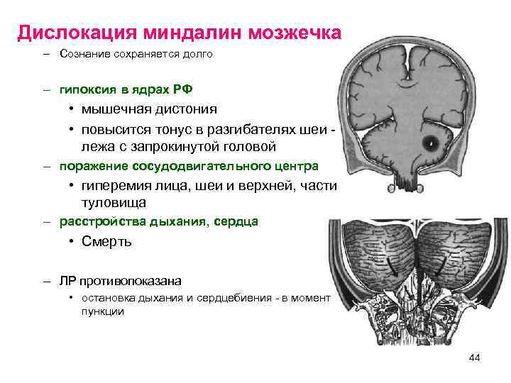 Дислокация миндалин мозжечка  – Сознание сохраняется долго – гипоксия в ядрах РФ 