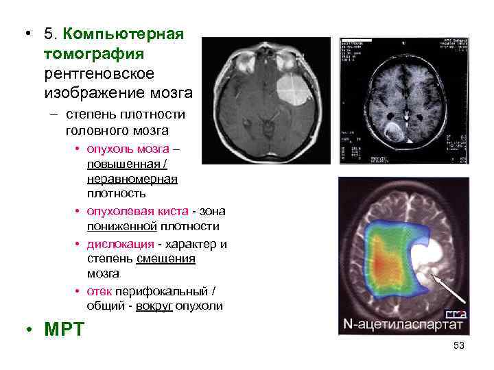  • 5. Компьютерная  томография  рентгеновское  изображение мозга  – степень