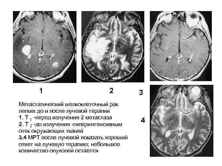   1    2   3 Метастатический мелкоклеточный рак легких