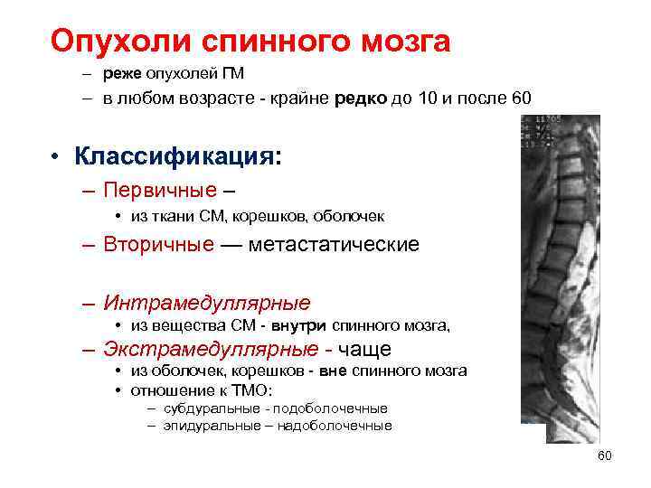Опухоли спинного мозга  – реже опухолей ГМ  – в любом возрасте 