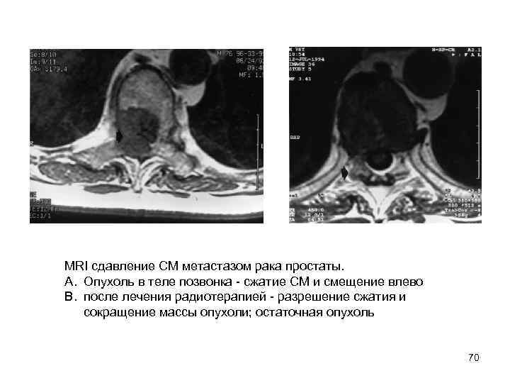MRI сдавление СМ метастазом рака простаты.  A. Опухоль в теле позвонка  сжатие