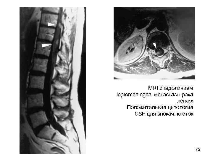   MRI с гадолинием leptomeningeal метастазы рака     легких Положительная