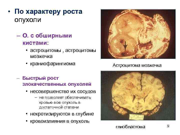  • По характеру роста  опухоли  – О. с обширными кистами: 