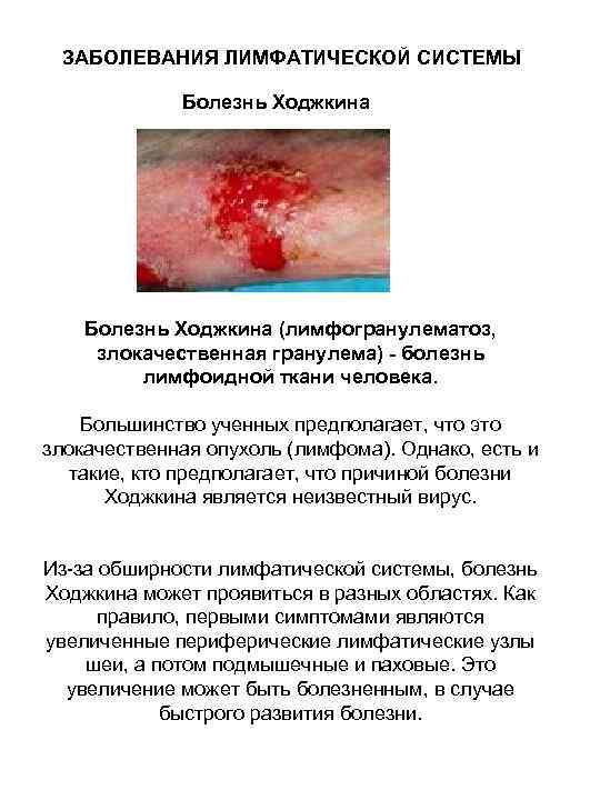  ЗАБОЛЕВАНИЯ ЛИМФАТИЧЕСКОЙ СИСТЕМЫ   Болезнь Ходжкина (лимфогранулематоз,  злокачественная гранулема) - болезнь