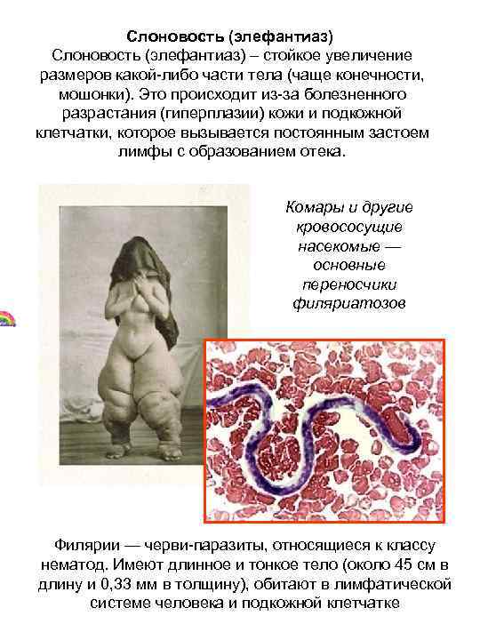   Слоновость (элефантиаз) – стойкое увеличение  размеров какой-либо части тела (чаще конечности,