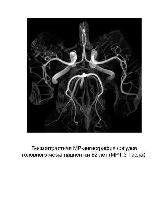 Мрт артерий головного. МР-ангиография артерий головного мозга. Бесконтрастная ангиография. Бесконтрастная МР ангиография сосудов. Кт ангиография сосудов заключение.