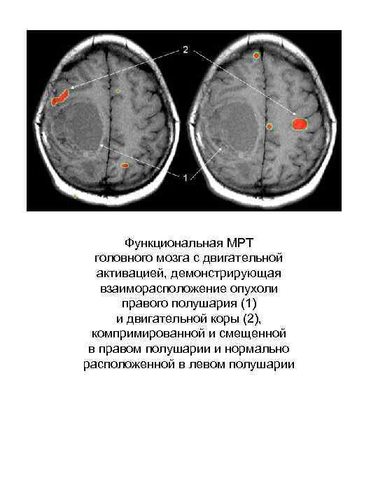   Функциональная МРТ  головного мозга с двигательной  активацией, демонстрирующая  взаиморасположение