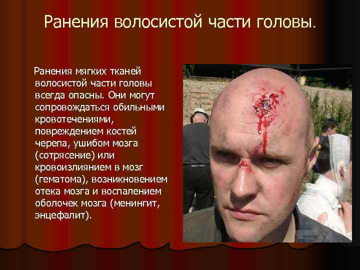  Ранения волосистой части головы.  Ранения мягких тканей волосистой части головы всегда опасны.