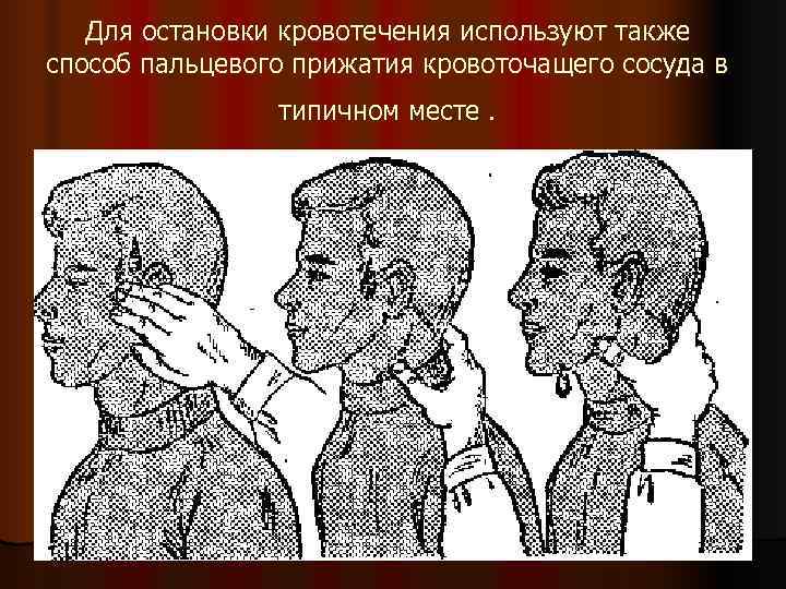   Для остановки кровотечения используют также способ пальцевого прижатия кровоточащего сосуда в 