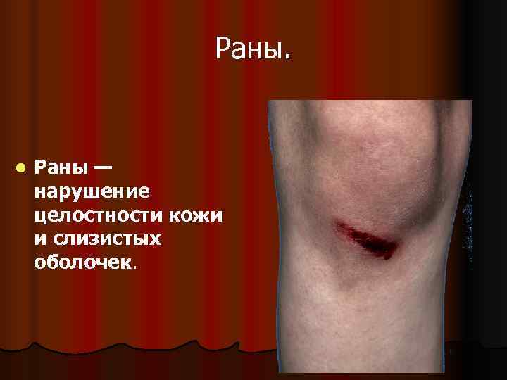     Раны.  l  Раны — нарушение целостности кожи и