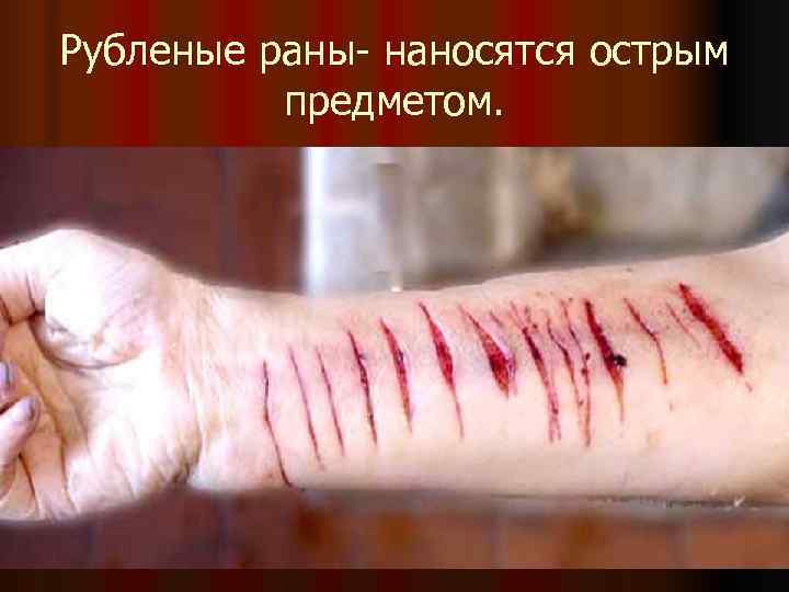 Рубленые раны- наносятся острым  предметом. 
