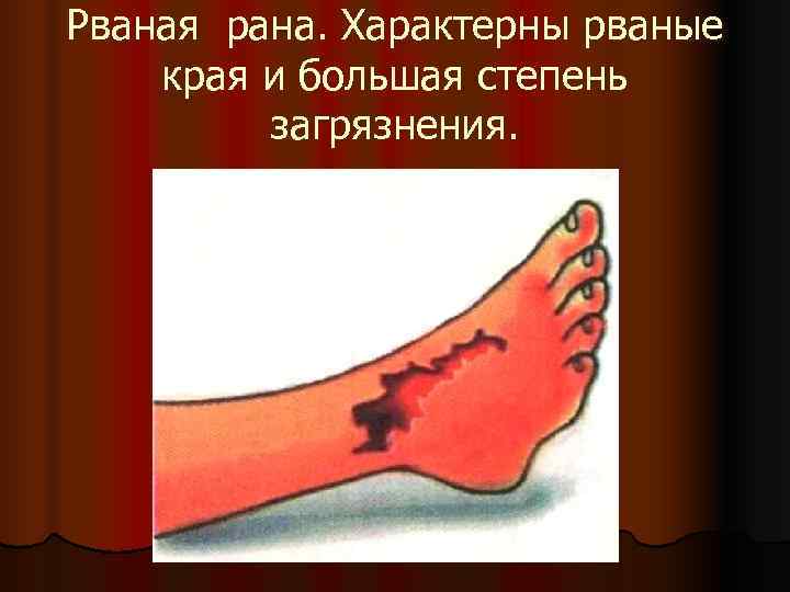 Рваная рана. Характерны рваные края и большая степень   загрязнения. 