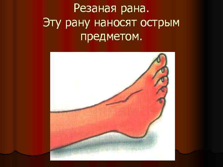  Резаная рана. Эту рану наносят острым  предметом. 