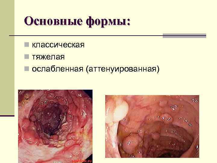 Основные формы: n классическая n тяжелая n ослабленная (аттенуированная) Основные формы: n классическая n тяжелая n ослабленная (аттенуированная)