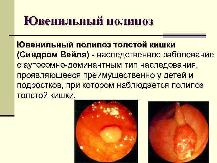 Ювенильный полипоз толстой кишки (Синдром Вейля) - наследственное заболевание с аутосомно-доминантным тип наследования, Ювенильный полипоз толстой кишки (Синдром Вейля) - наследственное заболевание с аутосомно-доминантным тип наследования,
