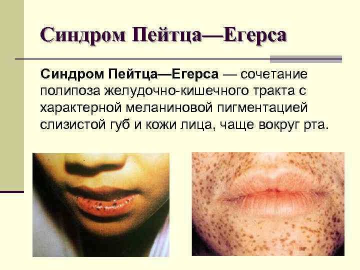 Синдром Пейтца—Егерса — сочетание полипоза желудочно-кишечного тракта с характерной меланиновой пигментацией слизистой губ и Синдром Пейтца—Егерса — сочетание полипоза желудочно-кишечного тракта с характерной меланиновой пигментацией слизистой губ и