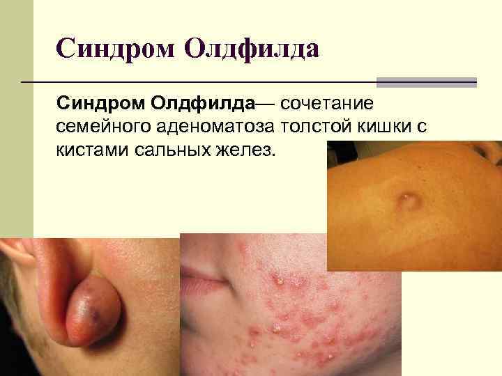 Синдром Олдфилда— сочетание семейного аденоматоза толстой кишки с кистами сальных желез. Синдром Олдфилда— сочетание семейного аденоматоза толстой кишки с кистами сальных желез.