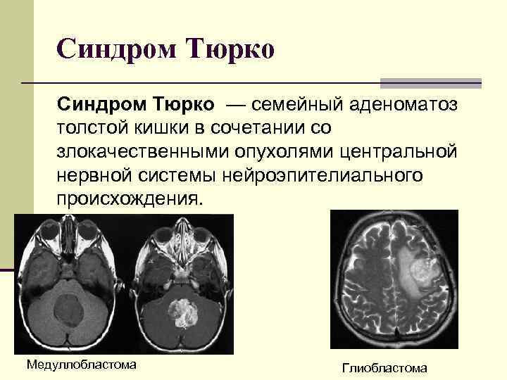 Синдром Тюрко — семейный аденоматоз толстой кишки в сочетании со злокачественными опухолями Синдром Тюрко — семейный аденоматоз толстой кишки в сочетании со злокачественными опухолями