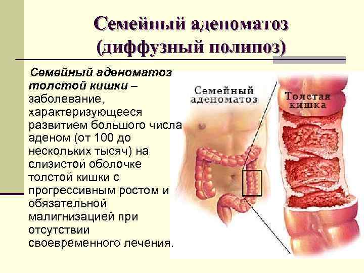 Семейный аденоматоз (диффузный полипоз) Семейный аденоматоз толстой кишки – заболевание, Семейный аденоматоз (диффузный полипоз) Семейный аденоматоз толстой кишки – заболевание,