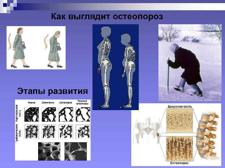  Как выглядит остеопороз Этапы развития 