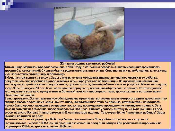       Женщина родила каменного ребенка! Жительница Марокко Зара забеременела