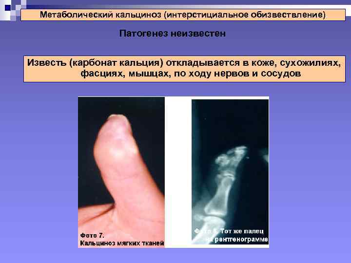  Метаболический кальциноз (интерстициальное обизвествление)    Патогенез неизвестен  Известь (карбонат кальция)