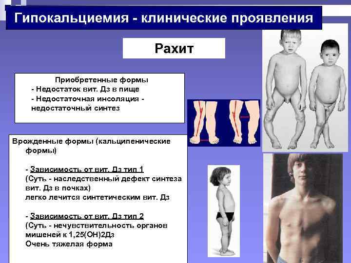 Дефицит кальция у детей. Наследственные заболевания рахит. Рахит недостаток витамина д. Костные изменения при рахите.