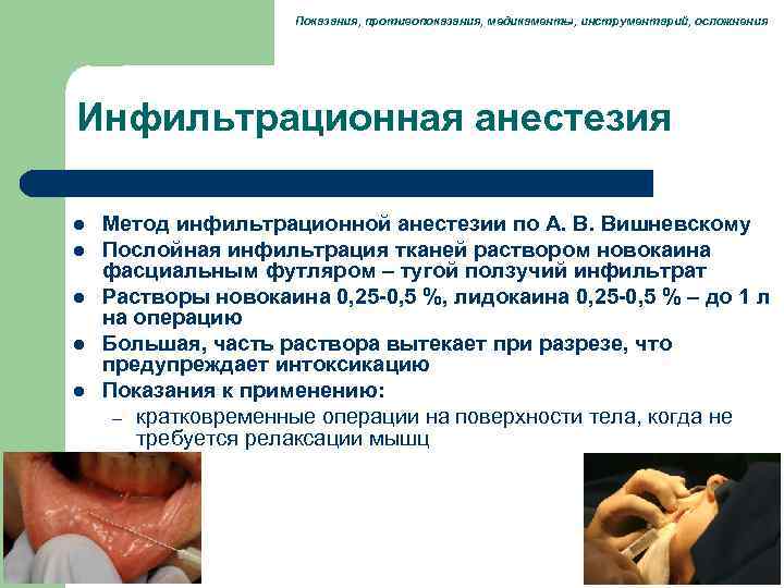      Показания, противопоказания, медикаменты, инструментарий, осложнения Инфильтрационная анестезия l 