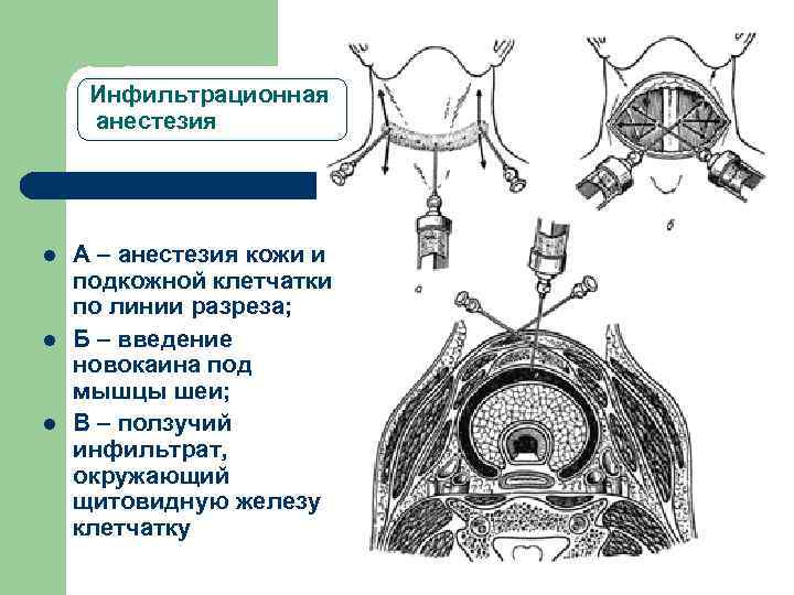  Инфильтрационная анестезия l  A – анестезия кожи и подкожной клетчатки по линии