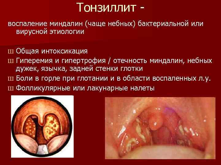    Тонзиллит - воспаление миндалин (чаще небных) бактериальной или  вирусной этиологии