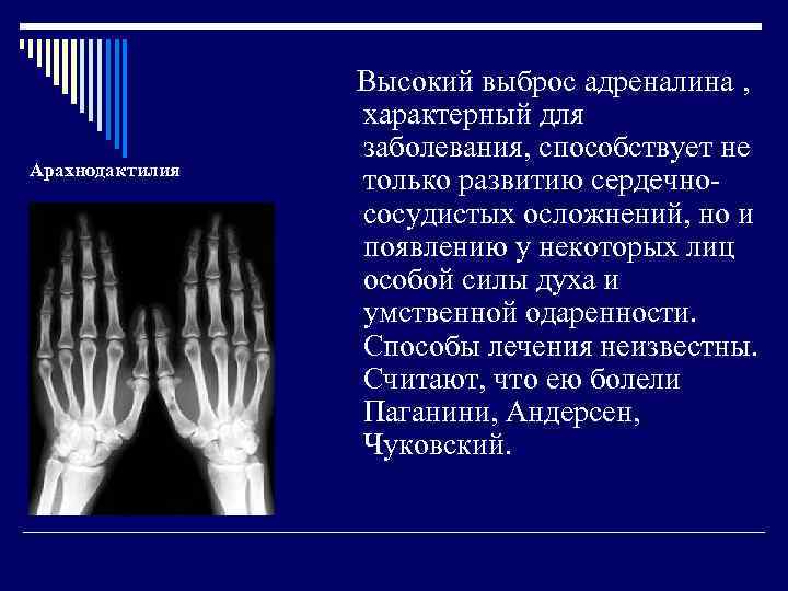     Высокий выброс адреналина ,    характерный для 