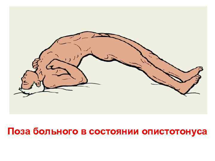Поза больного в состоянии опистотонуса 