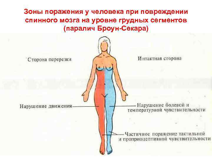 Зоны поражения у человека при повреждении спинного мозга на уровне грудных сегментов  (паралич