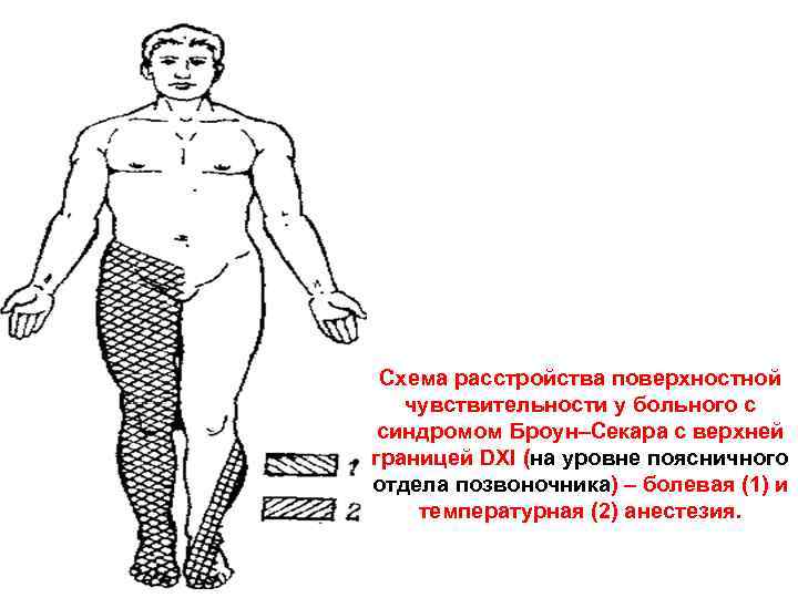  Схема расстройства поверхностной чувствительности у больного с  синдромом Броун–Секара с верхней границей