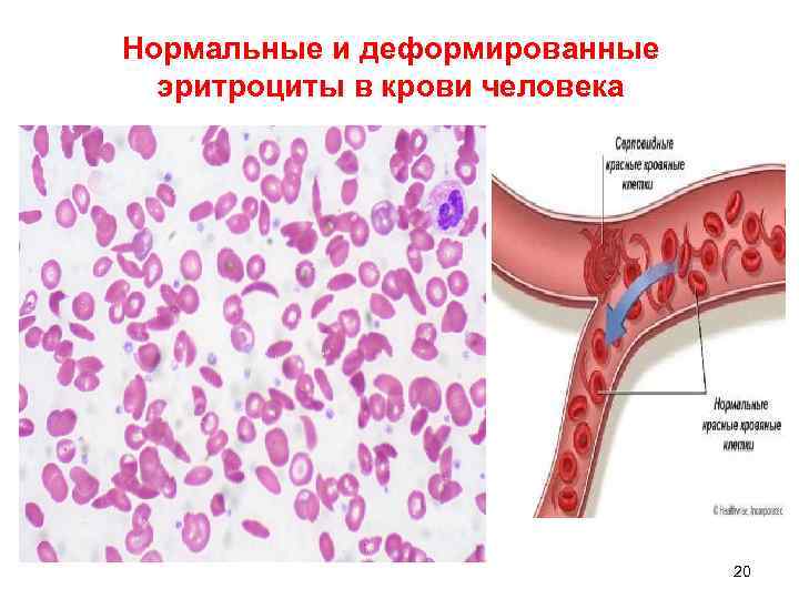 Нормальные и деформированные  эритроциты в крови человека      