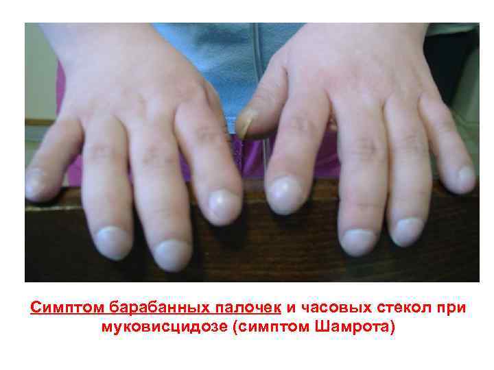 Симптом барабанных палочек и часовых стекол при   муковисцидозе (симптом Шамрота) 