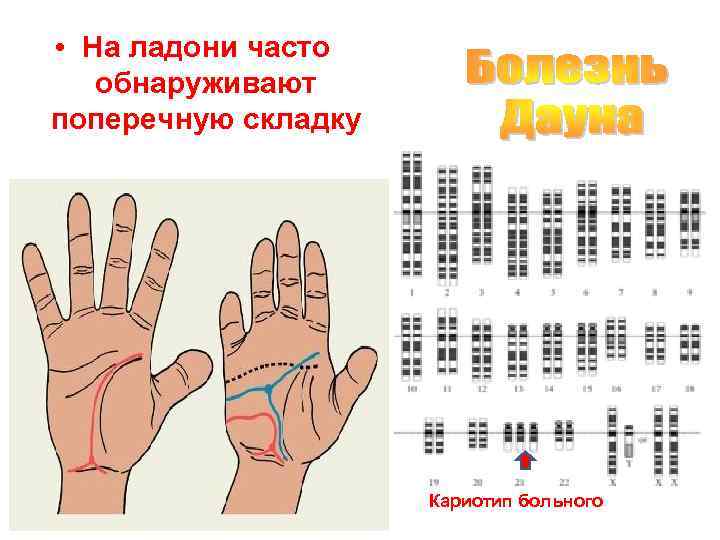  • На ладони часто обнаруживают поперечную складку      Кариотип