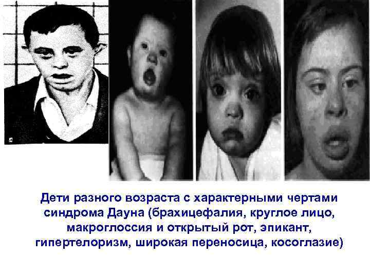  Дети разного возраста с характерными чертами  синдрома Дауна (брахицефалия, круглое лицо, 