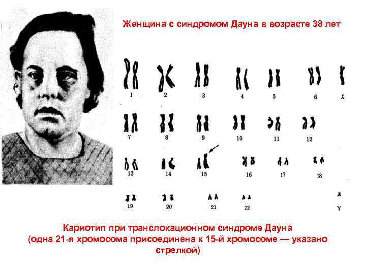     Женщина с синдромом Дауна в возрасте 38 лет  Кариотип