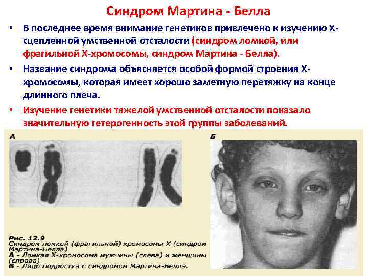    Синдром Мартина - Белла • В последнее время внимание генетиков привлечено