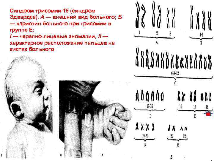Синдром трисомии 18 (синдром Эдвардса). А — внешний вид больного; Б — кариотип больного