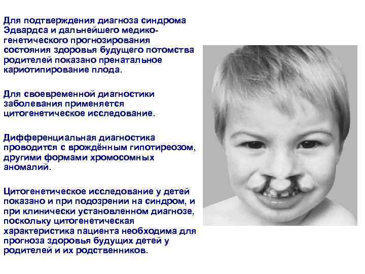 Для подтверждения диагноза синдрома Эдвардса и дальнейшего медико- генетического прогнозирования состояния здоровья будущего потомства