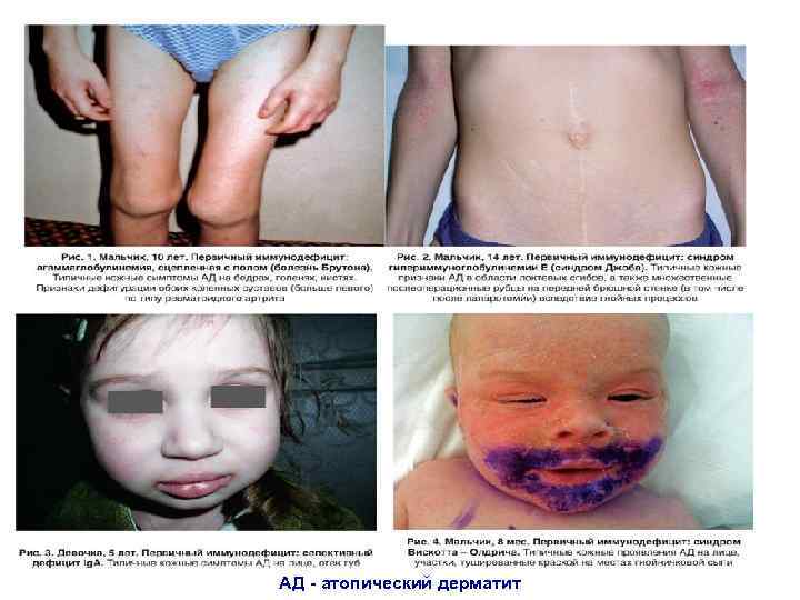 АД - атопический дерматит 